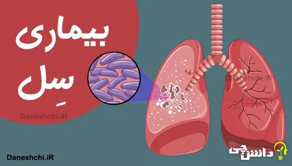 تحقیق درباره بیماری سل (TB) و نشانه های آن