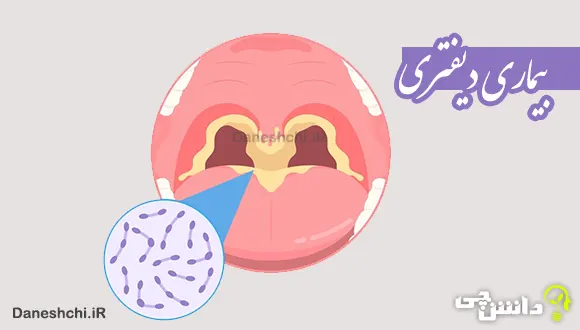 تحقیق در مورد بیماری دیفتری | علائم و راه های انتقال آن