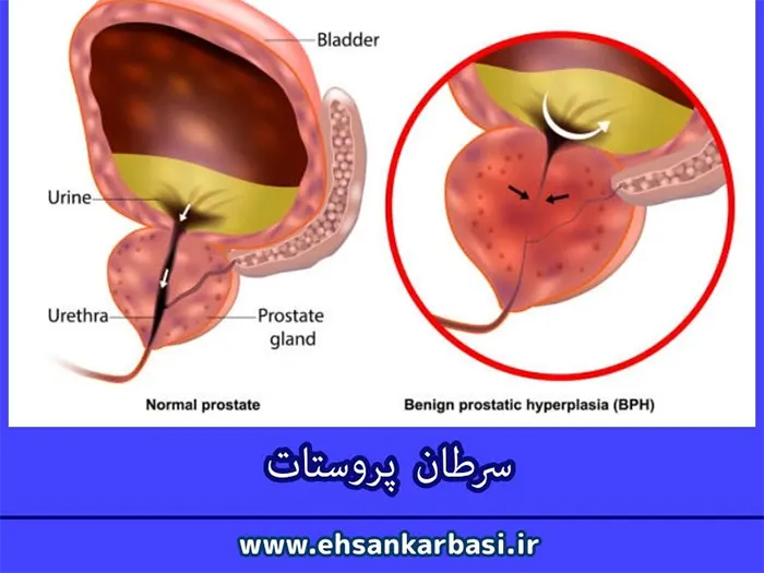 تشخیص زودهنگام سرطان پروستات