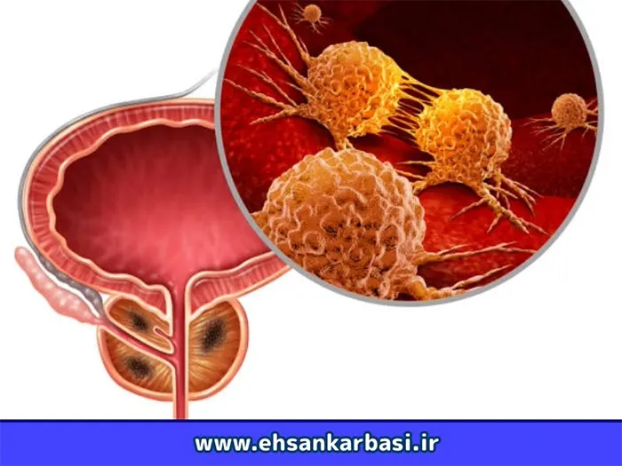 احتمال مرگ در سرطان پروستات