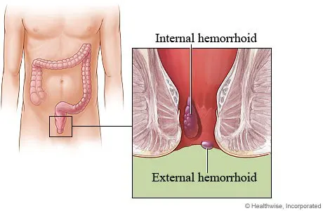 هموروئید یا بواسیر