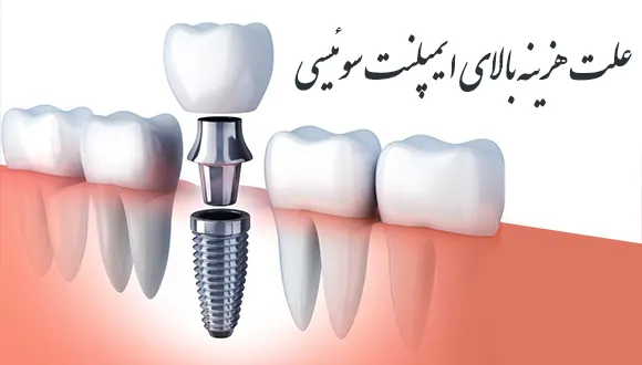 علت هزینه بالای ایمپلنت سوئیسی 