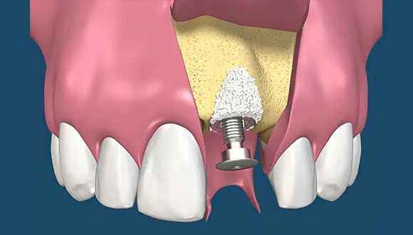 Grafting with Implant Placement