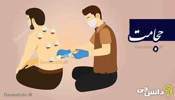حجامت چیست؟ عوارض و فواید آن