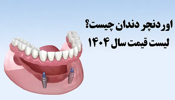 اوردنچر دندان چیه ؟ + قیمت اوردنچر دندان بر پایه ایمپلنت