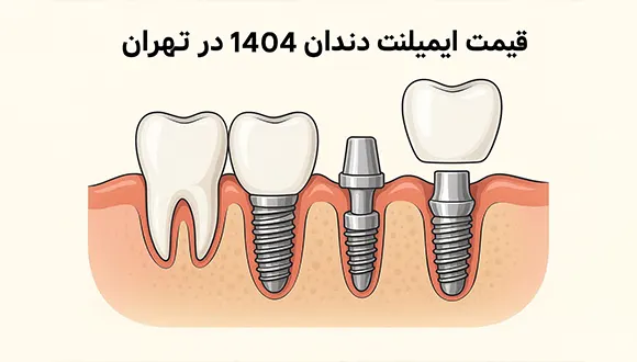 قیمت ایمپلنت دندان سال 1404; چه عواملی در هزینه نهایی تاثیرگذار هستند؟