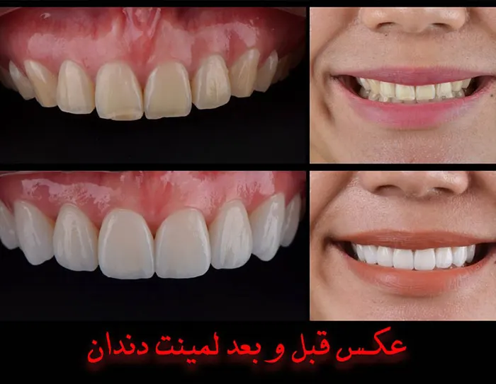 لمینت دندان طرح لبخند