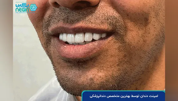 لمینت دندان و کاربردهای آن در دندانپزشکی زیبایی