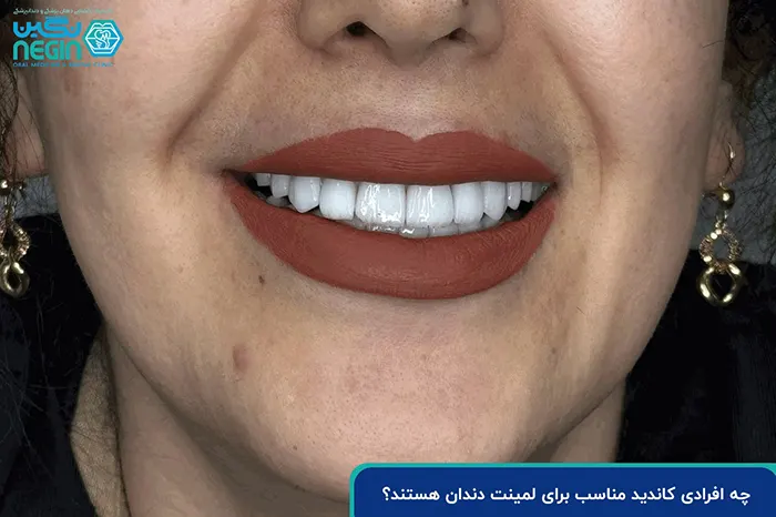 چه افرادی کاندید مناسب برای لمینت دندان هستند؟