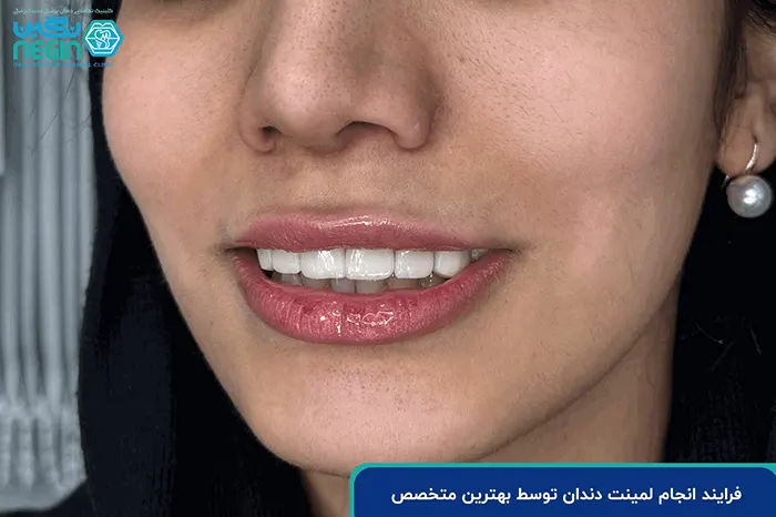 فرایند انجام لمینت دندان توسط بهترین متخصص