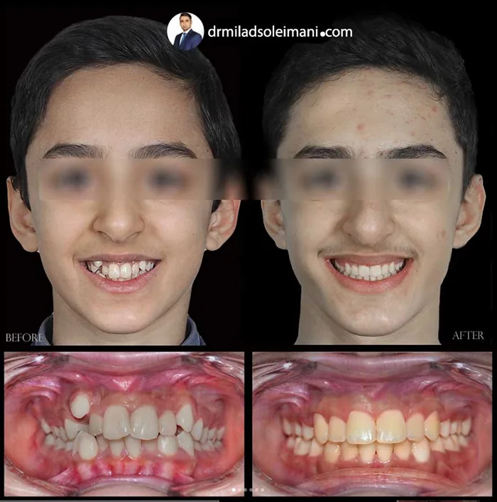 عکس قبل و بعد ارتودنسی دکتر میلاد سلیمانی 