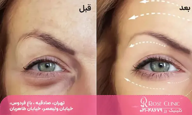 قبل و بعد فردی که تزریق مزوژل انجام داده است