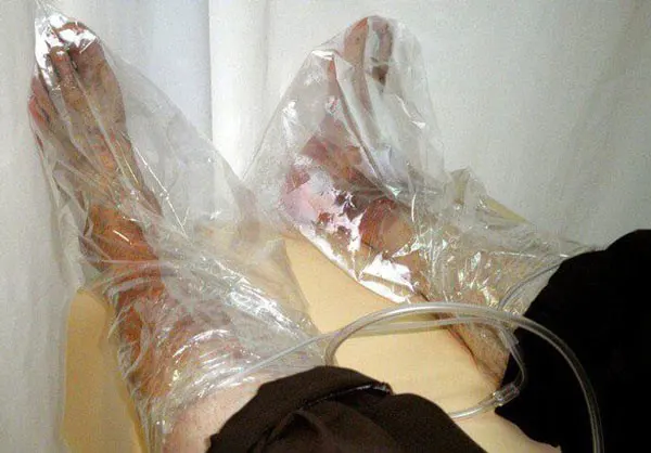 درمان زخم با اوزون تراپی