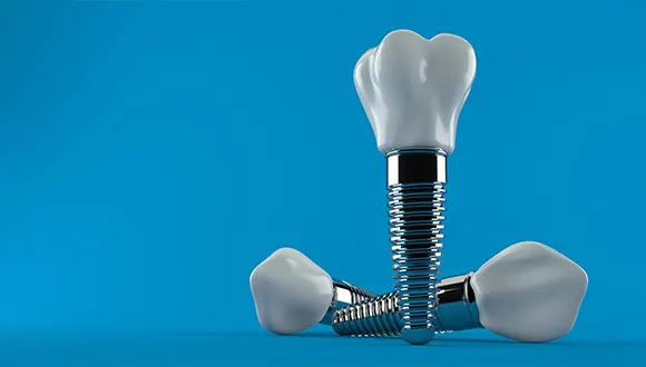 چگونه بهترین کلینیک با قیمت مناسب برای ایمپلنت دندان در تهرانپارس پیدا کنیم؟