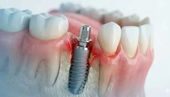 بعد از خراب شدن ایمپلنت چه باید کرد؟