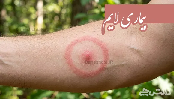 تحقیق در مورد بیماری لایم و علایم آن