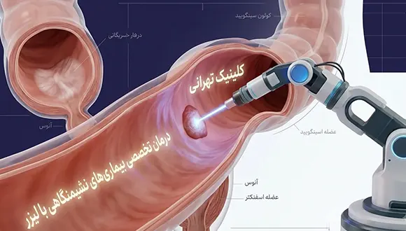 درمان غیرتهاجمی بیماریهای آنورکتال با لیزر