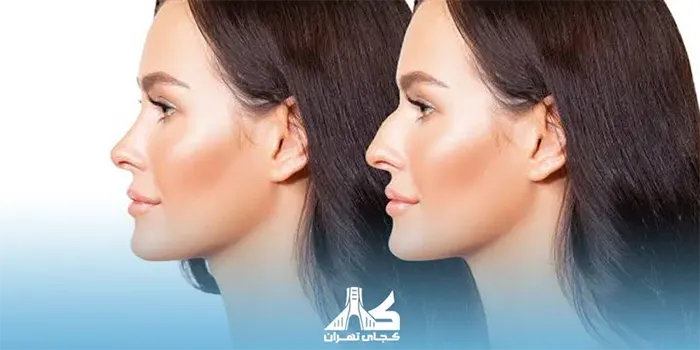 بعد از عمل بینی حالت سر باید چگونه باشد؟